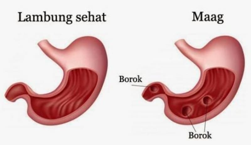 Illustration for article titled Obat Maag Herbal Paling Ampuh